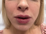 Lip Filler Case 1 After